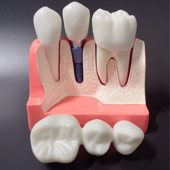 Модель зубного имплантата Съемный анализ Коронка мост Демонстрационная модель зубов Анализ зубного имплантата Модель зуба для обучения