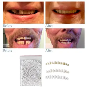 Мягкие формуемые виниры для зубов с подходящими бусинками Временные вставные челюсти